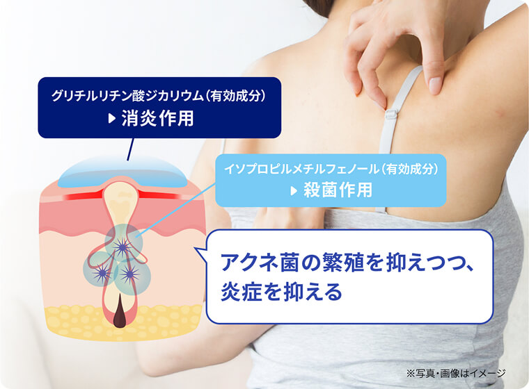 ダブルの有効成分でニキビ・肌荒れを防ぐ！